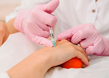 Проведение процедуры биоревитализации рук
